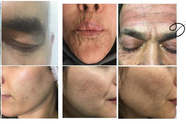 پلاسما تراپی یا پلاسماجت PLASMA THERAPY چیست؟و پلاسدرما PLASDERMA چه کاربردی دارد؟